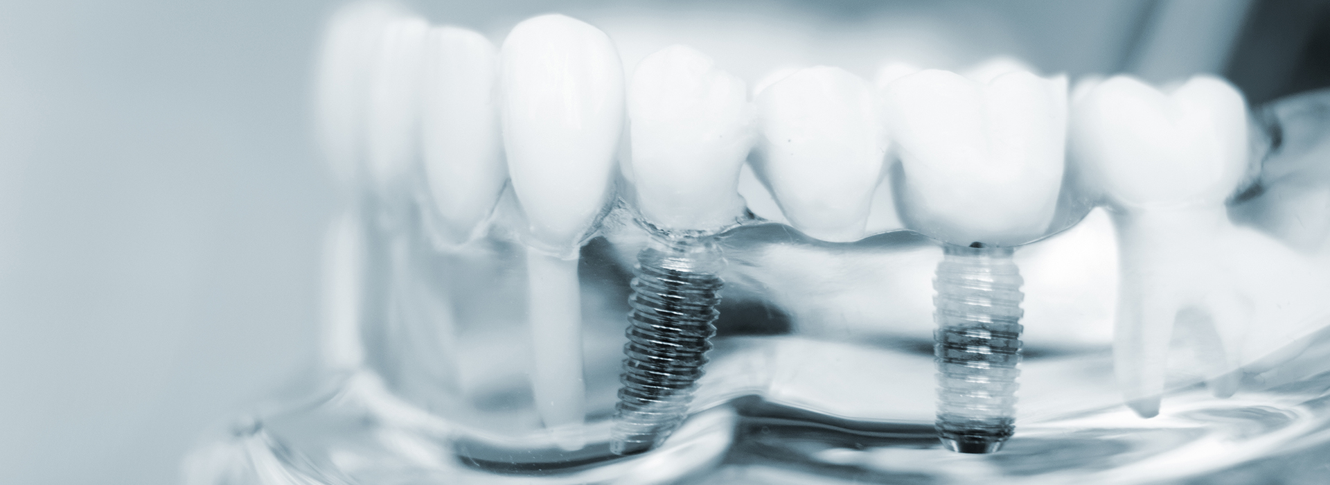Corey J. Walther, DDS   Associates | Root Canals, Implant Dentistry and Dental Bridges