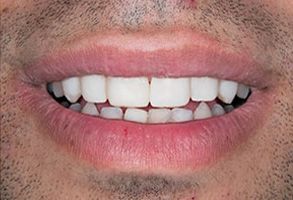 Corey J. Walther, DDS Associates | Dentures, Night Guards and All-on-4 reg