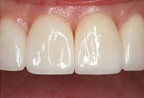 Corey J. Walther, DDS Associates | Teeth Whitening, Oral Cancer Screening and Ceramic Crowns