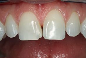 Corey J. Walther, DDS Associates | Veneers, Preventative Program and Emergency Treatment